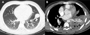 Tomografía pulmonar. A) TC de tórax simple, ventana parenquimal. Áreas de componente consolidativo atelectásico bilateral de predominio inferior izquierdo con un área noduliforme de 30mm periférica subpleural basal anteroizquierda adyacente al componente vascular. B) Angiotomografía de tórax. Se destacan estructuras vasculares anómalas a manera de malformación arteriovenosa en región inferoanteroizquierda dependiente de ramas segmentarias de la arteria pulmonar izquierda y eferencia hacia vena pulmonar inferoizquierda. Fuente: Hospital Nacional Edgardo Rebagliati Martins, Servicio de Imagenología.