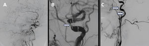 Panangiografía cerebral. A)Vista sagital de la panangiografía cerebral con presencia de ateromatosis generalizada. B)La flecha indica la presencia de ateromatosis y estenosis crítica a nivel del sifón carotídeo izquierdo. C)Las flechas indican la presencia de defectos de llenado debido a la presencia de algunos trombos móviles a nivel de la carótida interna izquierda.