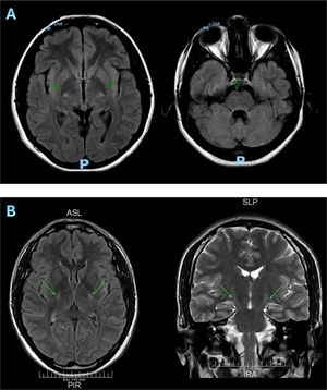 Hallazgos imagenológicos. RMI de los 2 pacientes (A y B) con hiperintensidad del haz piramidal.