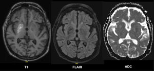 Hiperintensidad en secuencia T1 del estriado, predominantemente en el putamen derecho. Secuencia fluid attenuated inversion recovery (FLAIR) con hipointensidad en putamen derecho. Coeficiente de difusión aparente (ADC) sin evidencia de restricción a la difusión. Hallazgos compatibles con estriatopatía diabética.