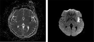 Lesión isquémica insular derecha en imagen de secuencia de difusión ponderada (DWI) y mapa del coeficiente de difusión aparente (ADC). Imagen de resonancia magnética que muestra una lesión en la región insular. A la derecha, DWI que evidencia una hiperintensidad focal en el ribete insular, indicativa de isquemia aguda. A la izquierda, ADC que revela una hipodensidad compatible con restricción a la difusión, confirmando el diagnóstico.