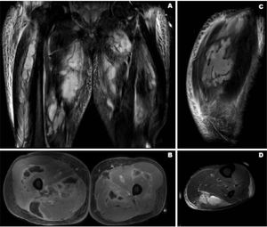 Resonancia magnética de muslos y piernas. Se observa colecciones hiperintensas en STIR en planos intermusculares en cara anterior de ambos muslos, comprometiendo planos profundos entre músculos aductores, cuádriceps y bíceps femoral (panel A y B). Se observan mismos hallazgos en gastrocnemio izquierdo (panel C y D).