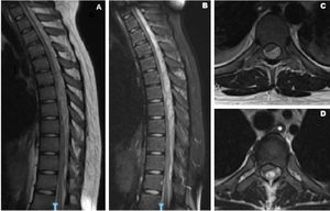 Resonancia magnética de columna dorsal. Se observa imagen intraaxial, extradural, heterogénea, isointensa en T1 (panel A y C), hiperintensa en STIR (panel B y D), ubicada en el espacio epidural posterior que se extiende desde C6-C7 hasta D10/D11. El mismo desplaza y comprime saco tecal y médula espinal.