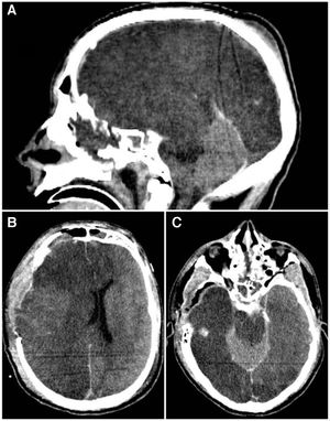 A) TC de cerebro corte sagital que demuestra el signo del cerebelo blanco, asociado a hipodensidad del tronco encefálico. B) TC de cerebro corte axial que evidencia desviación de la línea media por edema hemisférico derecho. C) TC de cerebro corte axial con evidencia de hiperdensidad relativa del cerebelo en relación a los hemisferios cerebrales.