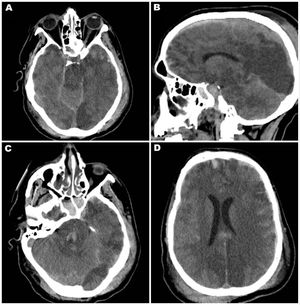 A y B) TC de cráneo en corte sagital y axial que evidencia el signo del cerebelo blanco. C) TC de cráneo en corte axial en la que se visualizan hemorragias de Duret en ell tronco. D) TC de cráneo en corte axial que demuestra desviación de la línea media por edema hemisférico izquierdo.