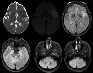 Resonancia magnética cerebral simple. Se observan cortes axiales en las secuencias ADC (coeficiente de difusión aparente), DWI (imagen ponderada por difusión) y FLAIR (recuperación de inversión atenuada por fluido) con restricción a la difusión en región insular izquierda con representación en la secuencia FLAIR. Los cortes axiales en territorio posterior no demuestran lesiones isquémicas.