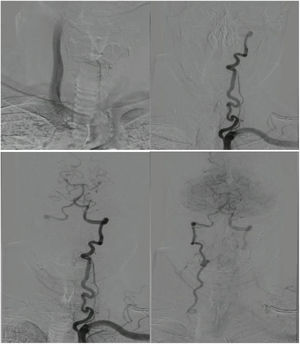 Angiografía cerebral y de vasos de cuello. Se cateteriza el tronco braquiocefálico derecho y se administra medio de contraste evidenciando ausencia de flujo hacia la porción proximal de la arteria subclavia y arteria vertebral derechas. Se realizaron adquisiciones secuenciales en tiempo arterial y proyecciones AP con cateterización selectiva e inyección de medio de contraste en arteria vertebral izquierda (Imagen superior derecha). En la tercera imagen (inferior izquierda) se observa adecuada opacificación de todos los segmentos de la arteria vertebral y de la circulación posterior. La cuarta imagen, con adquisición en tiempo capilar evidencia llenado por flujo retrógrado de la arteria vertebral derecha hasta su segmento V1 y territorio subclavio distal, compatible con fenómeno de robo subclavio.