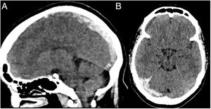 Tomografía de cráneo simple: A) en el corte sagital se aprecia una hiperdensidad en el seno sagital superior. B) en el corte transversal se observa una hiperdensidad a nivel del seno transverso derecho.