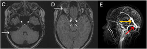 Resonancia de cráneo: C) secuencia ponderada en T1 y supresión grasa: la flecha indica un realce anómalo que corresponde a una ocupación trombótica del seno transverso derecho. D) secuencia ponderada en T1 y supresión grasa: la flecha indica el aplanamiento posterior del globo ocular derecho. E) reconstrucción 3D del sistema venoso: la flecha naranja indica una dilatación compensatoria del seno transverso. La flecha roja indica un flujo filiforme a nivel seno transverso derecho.