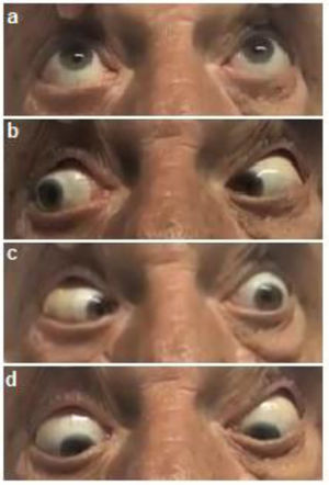 Hallazgos semiológicos. a) Supraducción conservada; b) Mirada lateral a derecha conservada; c) Mirada lateral a izquierda con déficit de la abducción del ojo izquierdo y d) Infraversión conservada.