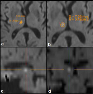 Resonancia magnética de cerebro, secuencia de difusión donde se observa hiperintensidad compatible con isquemia aguda. En figura a se observa el tamaño longitudinal y transversal de 5,7 y 8,1mm, respectivamente. En la figura b se observa el diámetro y el área de 7,3mm y 0,42cm2, respectivamente. En las figuras c y d se observa un corte sagital y coronal, respectivamente, donde se evidencia el compromiso exquisito del tálamo.