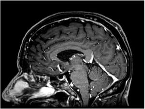RMN cerebral, corte sagital, secuencia T1 con contraste.