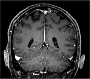Corte coronal, secuencia T1, corte axial, con contraste. En ambas podemos observar alteración difusa de la señal con múltiples imágenes pseudonodulares en calota y base del cráneo que realzan tras la administración del medio de contraste endovenoso, en relación a enfermedad de base.