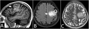 Resonancia magnética cerebral. A) Corte sagital, en secuencia en T1, con una gran masa frontal izquierda (flechas blancas). B) En la secuencia T2 – TIRM se observa hiperintensidad heterogénea con quiste intratumoral. C) En la secuencia T2 – TSE se observa la afectación de la corteza y sustancia blanca.