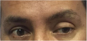 Se solicitó al paciente que mire al frente; el ojo izquierdo se desvía hacia afuera acompañado por una ptosis palpebral incompleta por compromiso del III nervio craneal ipsilateral (se muestra hiperintenso en la Figura 3B).