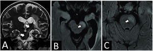 Resonancia magnética cerebral. A) Corte coronal, en secuencia en T2, con señal hiperintensa en la vía cortico espinal izquierda (flechas blancas), compatible con degeneración walleriana en tercera fase. B) En la secuencia FLAIR se observa hiperintensidad a nivel del pie del pedúnculo cerebral izquierdo (obsérvese el III nervio craneal hiperintenso). C) En la secuencia FLAIR, a nivel del pie protuberancial izquierdo.