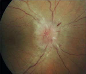 Ojo derecho. Imagen de fondo de ojo con edema de papila.