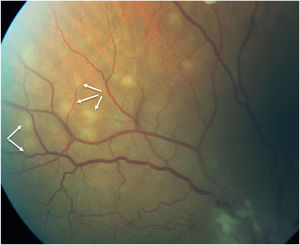 Ojo izquierdo. Lesiones redondeado-ovaladas coriorretinianas blanco-amarillentas de predominio en zonas nasales y superiores con disposición en perdigonada (flechas) compatibles con BCR.
