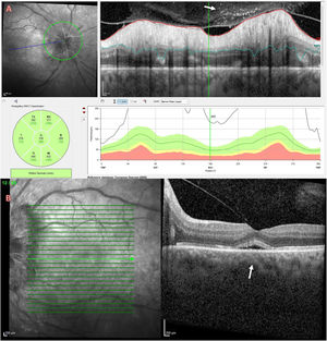 A) OCT papilar de ojo derecho, donde se observan puntos de mayor hiperreflectividad (flechas), indicativos de aumento de celularidad vítrea (vitritis) a nivel prepapilar. B): OCT macular de ojo izquierdo. Además de un aumento de la celularidad vítrea prerretiniana, se constata un desprendimiento neurosensorial macular (flecha).
