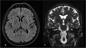 3T. Brain contrast enhanced magnetic resonance imaging. (A) Axial FLAIR sequence demonstrating mild temporal and frontal lobe atrophy. (B) Coronal T2-weighted sequence demonstrating adequate hippocampal visualization and mild temporal and frontal lobe atrophy.