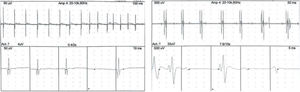Descargas espontáneas de unidades motoras en 2.° dorsal interóseo y abductor del quinto dedo, rítmicas, en singuletes y dupletes con una frecuencia de 7Hz, compatible con descargas mioquímicas.