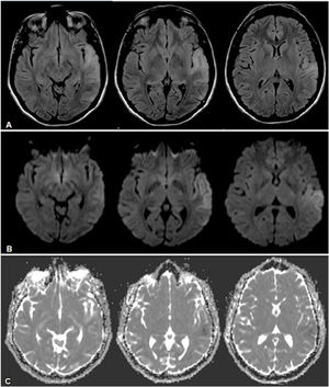 RMN de cerebro donde se observa lesión hiperintensa a nivel temporal lateral izquierdo en secuencias FLAIR (A), con restricción parcial a nivel cortical a predominio posterior indicativo de áreas de edema citotóxico y otras áreas de efecto T2 a predominio yuxtacortical temporal anterior, indicativo de edema vasogénico en secuencias DWI (B) y ADC (C).