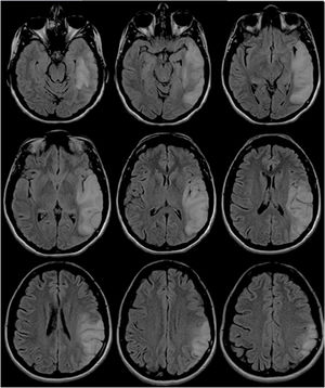 RMN de cerebro donde se evidencia la progresión de la extensión de la lesión hiperintensa a nivel temporoparietal izquierdo en secuencia FLAIR.