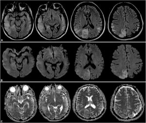 RMN de cerebro donde se observa extensa lesión hiperintensa en secuencia FLAIR (A) a nivel temporooccipitoparietal derecha con restricción a la secuencia DWI asociado a edema vasogénico (B y C).