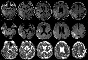 RMN de cerebro donde se observa lesión hiperintensa a nivel temporoparietooccipitoinsular derecha en secuencias FLAIR (A), con restricción a predominio cortical indicativo de áreas de edema citotóxico y áreas de efecto T2 a predominio yuxtacortical, indicativo de edema vasogénico en secuencias DWI (B) y ADC (C).