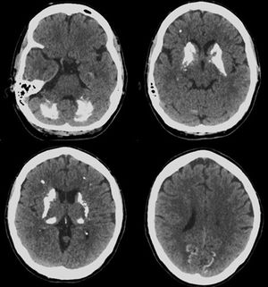 Tomografía de cráneo simple. Calcificaciones en ganglios basales, sustancia blanca de región frontal en centro semioval, parietooccipital y cerebeloso en forma bilateral.