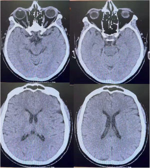 Tomografía axial de cráneo simple en la cual no se observan datos de isquemia, hemorragia ni edema cerebral; se reportó como estudio de imagen normal.