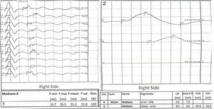 A) Neuroconducción motora: pruebas especiales de ondas F con diferencia interlado significativa de nervio mediano y con latencias aumentadas. B) Neuroconducción sensorial: latencia aumentada para mediano derecho, resto con latencias y amplitudes normales. Neuro conducción motora: velocidad de neuroconducción motora disminuida para nervio mediano bilateral.