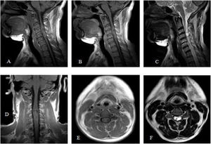 Corte sagital: T1 simple (A) y contrastado (B), T2 (C). Corte coronal: T1 contrastado (D). Corte axial T1 contrastado (E) y T2 (F).