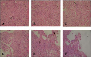 Se observa proliferación neoplásica de células fasocelulares de cromatina fina, sin nucléolos ni inclusiones, organizadas alrededor de espacios pausicelulares, ausencia de mitosis, algunas con pigmento pardo intracitoplasmático.