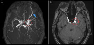 Angiografía por resonancia magnética con contraste. A)Proyección de máxima intensidad que muestra pérdida de definición de la porción intracavernosa de la arteria carótida interna con agrandamiento de la vena oftálmica superior ipsilateral (flecha azul). B)Imagen ponderada en T1 que muestra asimetría de la luz de la porción cavernosa de la arteria carótida interna izquierda con extravasación de material de contraste paramagnético al seno cavernoso ipsilateral.