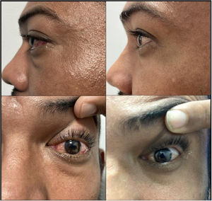 Comparación lateral y frontal preintervención y postintervención. Presencia de ptosis, quemosis y edema conjuntival.