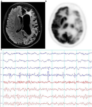 A) RM de cerebro secuencia FLAIR (fluid attenuated inversion recovery, por sus silgas en inglés) con evidencia de atrofia del hemisferio izquierdo. B) PET donde se observa hipometabolismo de hemisferio izquierdo a predominio frontotemporoparietal. C) EEG donde se observa la presencia de puntas y polipuntas semiperiódicas en región occipital izquierda asociada a un trazado asimétrico a expensas de menor amplitud y frecuencia a nivel del hemisferio izquierdo.