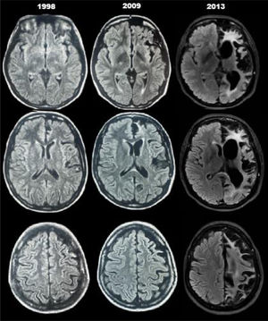 RM de cerebro sin contraste de los años 1998, 2009 y 2013 donde se observa la progresión de la atrofia unihemisférica.