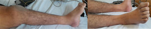 Atrofia muscular distal de ambos miembros inferiores.