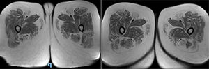 Imagen de resonancia magnética de ambos muslos en secuencia T1.