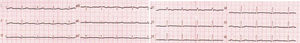 Electrocardiograma.