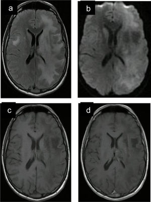 Resonancia magnética nuclear de cráneo (caso clínico n.° 8). Lesión subcortical y yuxtacortical frontal derecha y fronto-parieto-occipital, cápsula interna, tálamo y núcleo lenticular izquierdo hiperintensa FLAIR (a), tenue restricción de señal en DWI (b), hipointensa en T1 (c), sin realce con contraste EV (d).