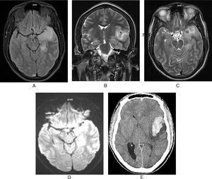 Neuroimágenes. Resonancia magnética cerebral simple: hiperintensidad de señal en secuencia FLAIR (A) y T2 (B y C), comprometiendo corteza y región subcortical temporal e insular izquierda afectando el hipocampo y amígdala hipocampal, efecto de masa local, sútil restricción en la secuencia de difusión (D) de algunas áreas. Los hallazgos condicionan efecto de masa con borramiento de los espacios subaracnoideos y leve desplazamiento de la línea media hacia el lado derecho de aproximadamente 3,5mm. E) TAC de cráneo simple: Imagen hiperdensa en rango de sangre en corteza, región insular y temporal izquierda con cambios inflamatorios locales medidas aproximadas de 55×59×30mm, el cual ejerce efecto de masa con borramiento de los espacios subaracnoideos y desplazamiento de la línea media hacia el lado derecho de 7,8mm, con extensión del sangrado intraparenquimatoso a las astas inferiores del sistema ventricular