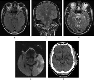 Neuroimágenes. Resonancia magnética cerebral simple: F) Hiperintensidad cortico subcortical en lóbulo temporal lateral y mesial izquierdo en secuencia FLAIR corte axial y corte coronal de toda la corteza temporal medial lateral e ínsula (G). H) hiperintensidad de señal en secuencia T2 axial en lóbulo temporal medial y mesial izquierdo. I) Secuencia de difusión con hiperintensidad temporal y mesial izquierdo. J) TAC de cráneo simple: Hipodensidad temporal mesial y lateral e ínsula con lesión hiperdensa hipocampal, correspondiente a pequeño sangrado.