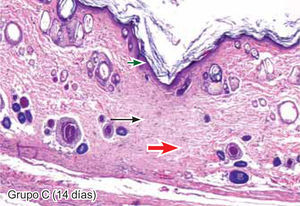 Tejido suturado con CAC-B. Se aprecia ausencia de infiltrado polimorfonuclear, presencia de tejido conectivo denso (flecha gruesa), fibroblastos jóvenes (flecha negra) y engrosamiento de la epidermis (flecha corta) (4X).