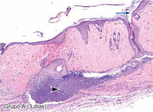 Tejido suturado con poliglactina 910, se observa engrosamiento de epidermis (flecha larga), gran cantidad de eritrocitos y presencia de infiltrado polimorfonuclear severo (cabeza de flecha) (4X).