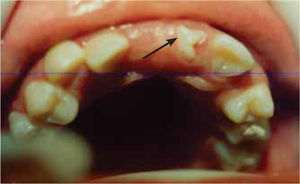Retención del incisivo central superior derecho, presencia de un diente de forma irregular, en malposición dentaria.