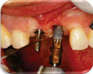 Colocación de los implantes Nobel Replace® Ti U de 3.5x13mm.