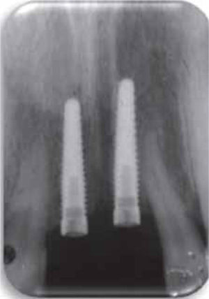Radiografía dentoalveolar de control tras la colocación de los implantes.