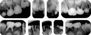 Radiografías dentoalveolares en donde se observan pulpotomías profilácticas y pulpectomías en dientes afectados por abscesos. Restauraciones a base de coronas de acero cromo y resinas.